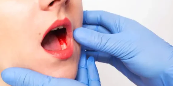 Ağız Kokusu Neden Olur?